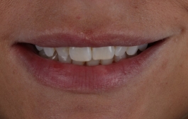 Smile Gallery - Church Road Dental and Cosmetic