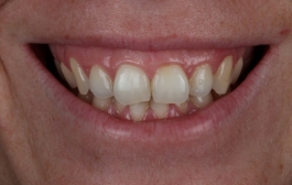Smile Gallery - Church Road Dental and Cosmetic