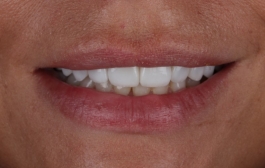 Smile Gallery - Church Road Dental and Cosmetic