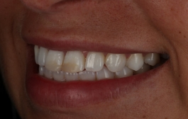 Smile Gallery - Church Road Dental and Cosmetic