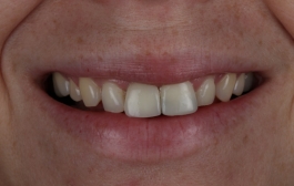 Smile Gallery - Church Road Dental and Cosmetic