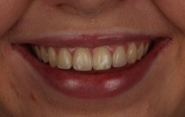 Smile Gallery - Church Road Dental and Cosmetic