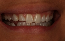 Smile Gallery - Church Road Dental and Cosmetic