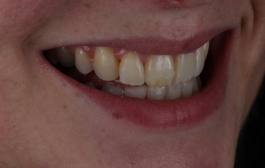 Smile Gallery - Church Road Dental and Cosmetic