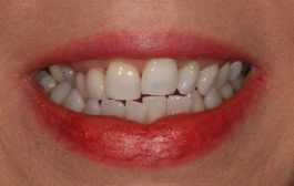 Smile Gallery - Church Road Dental and Cosmetic