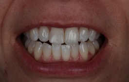 Smile Gallery - Church Road Dental and Cosmetic