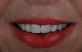 Smile Gallery - Church Road Dental and Cosmetic