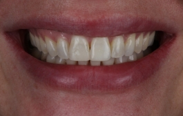 Smile Gallery - Church Road Dental and Cosmetic