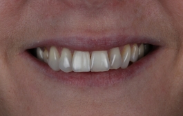 Smile Gallery - Church Road Dental and Cosmetic