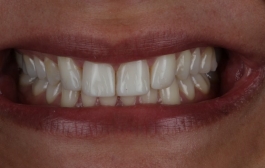 Smile Gallery - Church Road Dental and Cosmetic