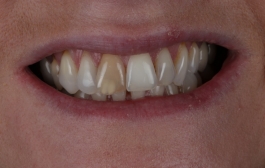 Smile Gallery - Church Road Dental and Cosmetic
