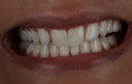 Smile Gallery - Church Road Dental and Cosmetic