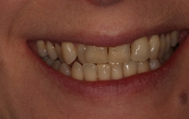 Smile Gallery - Church Road Dental and Cosmetic