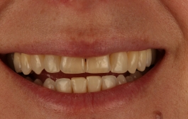 Smile Gallery - Church Road Dental and Cosmetic