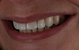 Smile Gallery - Church Road Dental and Cosmetic