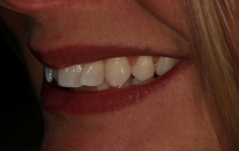 Smile Gallery - Church Road Dental and Cosmetic