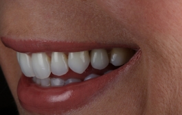 Smile Gallery - Church Road Dental and Cosmetic
