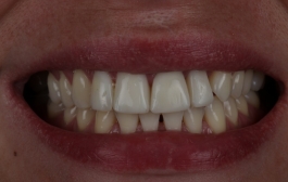 Smile Gallery - Church Road Dental and Cosmetic