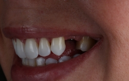Smile Gallery - Church Road Dental and Cosmetic