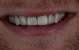 Smile Gallery - Church Road Dental and Cosmetic