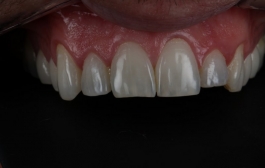 Smile Gallery - Church Road Dental and Cosmetic