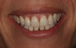 Smile Gallery - Church Road Dental and Cosmetic