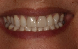 Smile Gallery - Church Road Dental and Cosmetic