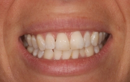 Smile Gallery - Church Road Dental and Cosmetic