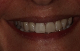 Smile Gallery - Church Road Dental and Cosmetic