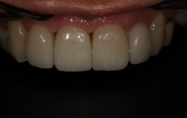 Smile Gallery - Church Road Dental and Cosmetic