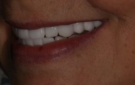 Smile Gallery - Church Road Dental and Cosmetic