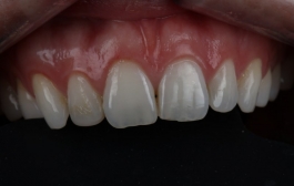 Smile Gallery - Church Road Dental and Cosmetic