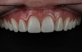Smile Gallery - Church Road Dental and Cosmetic