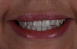 Smile Gallery - Church Road Dental and Cosmetic