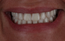 Smile Gallery - Church Road Dental and Cosmetic