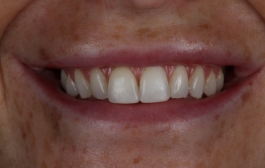 Smile Gallery - Church Road Dental and Cosmetic