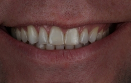 Smile Gallery - Church Road Dental and Cosmetic