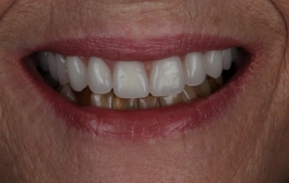 Smile Gallery - Church Road Dental and Cosmetic