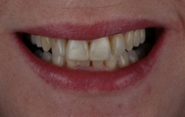 Smile Gallery - Church Road Dental and Cosmetic