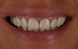 Smile Gallery - Church Road Dental and Cosmetic