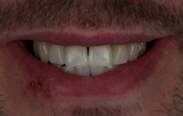 Smile Gallery - Church Road Dental and Cosmetic