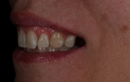 Smile Gallery - Church Road Dental and Cosmetic