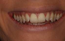 Smile Gallery - Church Road Dental and Cosmetic