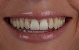 Smile Gallery - Church Road Dental and Cosmetic