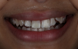 Smile Gallery - Church Road Dental and Cosmetic