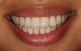 Smile Gallery - Church Road Dental and Cosmetic