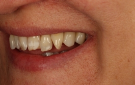 Smile Gallery - Church Road Dental and Cosmetic