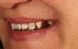 Smile Gallery - Church Road Dental and Cosmetic