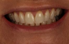 Smile Gallery - Church Road Dental and Cosmetic