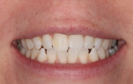 Smile Gallery - Church Road Dental and Cosmetic